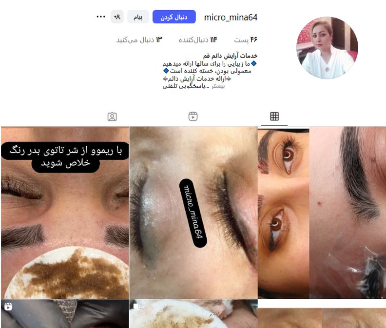 میکروبلیدینگ، نانوبروز و فیبروز کانتوربروز (سالن حجاب)