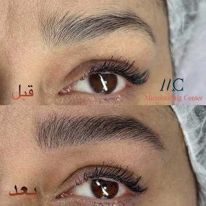 میکروبلیدینگ در اصفهان